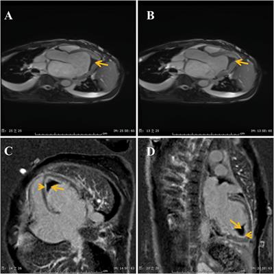 Case report: Application of non-VKA oral anticoagulants in patient of idiopathic hypereosinophilic syndrome with intracardiac thrombus